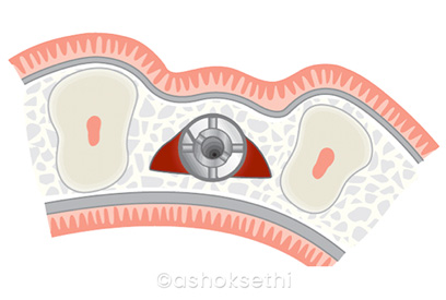 Bone Expansion