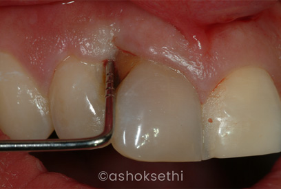 Multiple Teeth Missing (With Bone Graft)