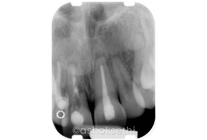 Multiple Teeth Missing (With Bone Graft)