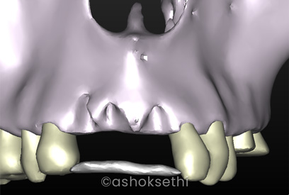 Multiple Teeth Missing (With Bone Graft)