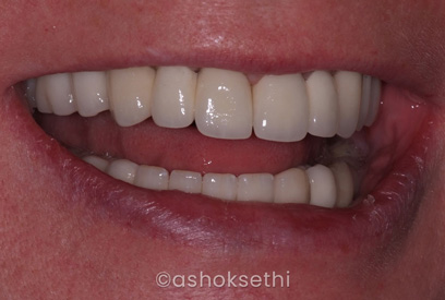 Multiple Teeth