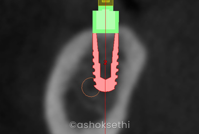 Nerve Repositioning