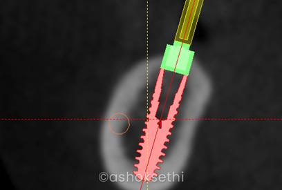 Nerve Repositioning