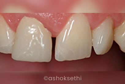 Same Day Dental Implants