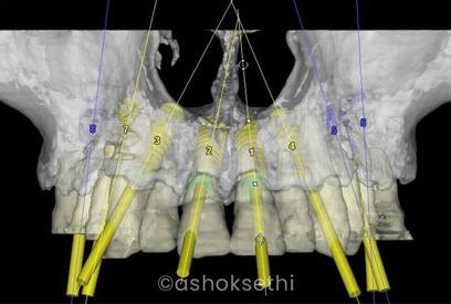 Same Day Dental Implants