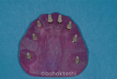 Same Day Dental Implants