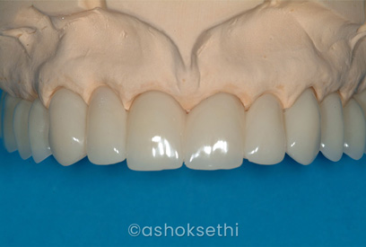 Same Day Dental Implants