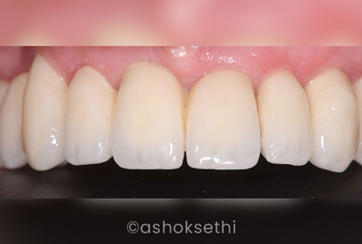 Same Day Dental Implants