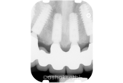 Same Day Dental Implants