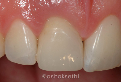 Same Day Dental Implants