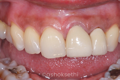 Same Day Dental Implants