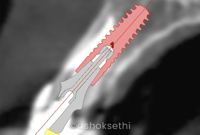 Same Day Dental Implants