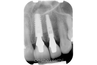 Same Day Dental Implants