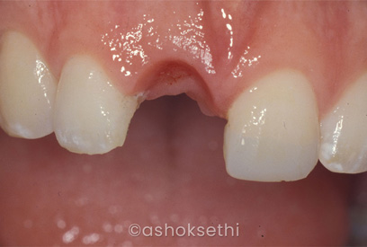 Single Teeth
