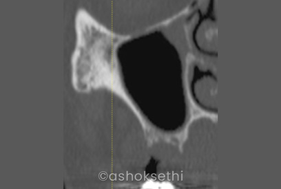 Sinus Lifts